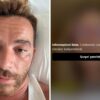 salmo melanoma video cancro alla pelle